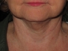post-op-5-months-smartlipo-chin-silhouette-lift-and-neck-lift