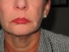 post-op-1month-mid-face-and-neck-lift-center-view