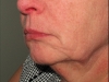 pre-op-mid-face-and-neck-lift-left-view